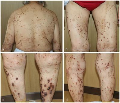 Effectiveness of baricitinib in acquired reactive perforating collagenosis: a case report